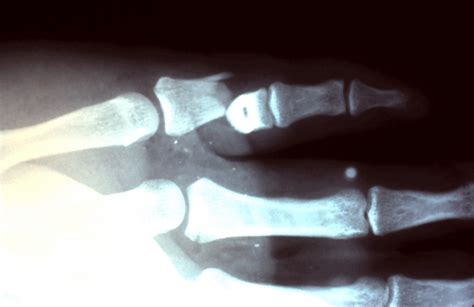 Proximal Phalanx Fracture The Hand Treatment Center New Jerseynew