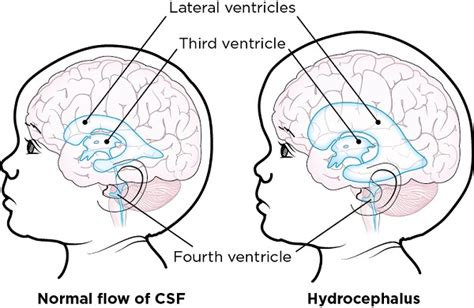 Hydrocephalus Vs Normal Brain