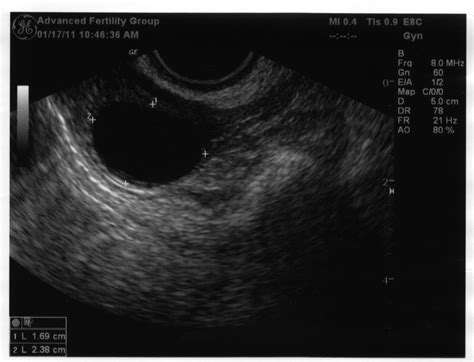 Bonnies Babies Day 13 Follicle Scan And Hcg