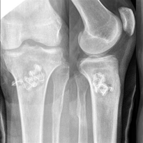 An Osteolytic Metaphyseal Bone Lesion In The Proximal Tibia Without New