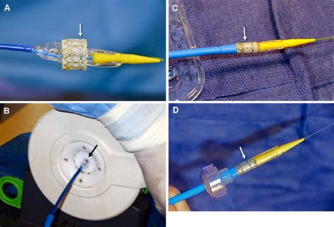 The Edwards Sapien Transcatheter Heart Valve For Calcific Aortic