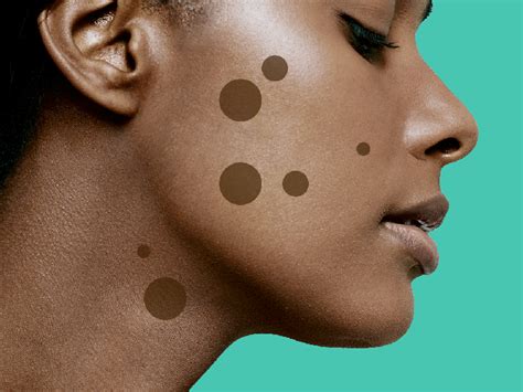 8 Dark Spot Treatments That Really Work According To Dermatologists Self