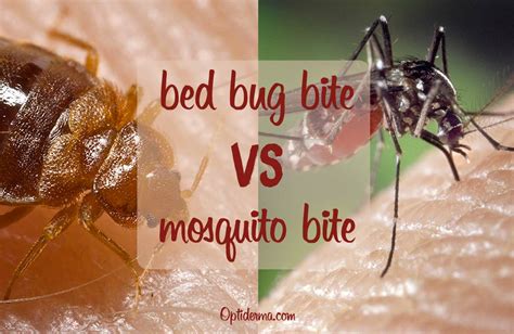 Bed Bug Bites Vs Mosquito Bites Whats The Difference Nov My Xxx Hot Girl