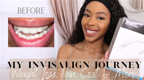 My Invisalign Journey Weight Loss Cost Pain And The Process Youtube