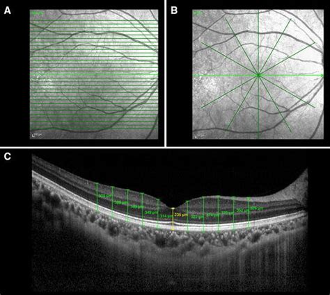 Optical Coherence Tomography OCT Scans A OCT Scan Using The Raster
