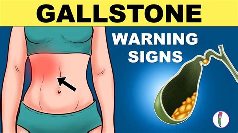 Gallbladder Stones Symptoms Cholelithiasis Gallstones Symptoms
