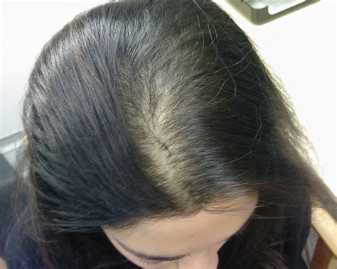 The Hair Loss Centre FEMALE HAIR LOSS PHOTOS TREATED