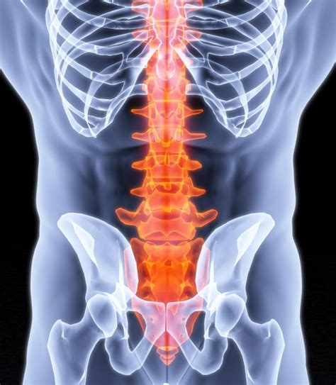 What Is Lumbar Spondylosis With Pictures
