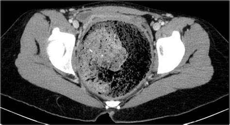 Ct Scan Showing Megarectum And Fecaloma In The Axial Section
