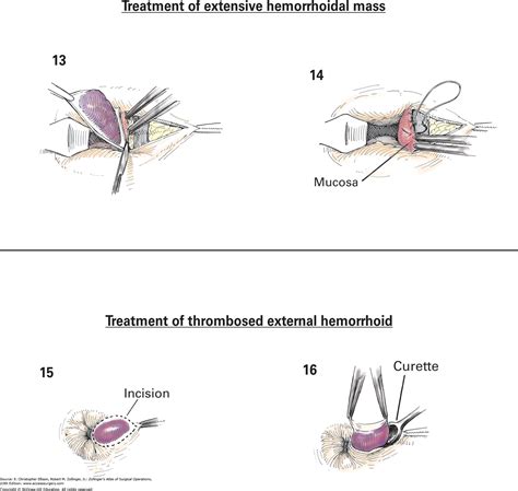 External Hemorrhoid With Blood Clot