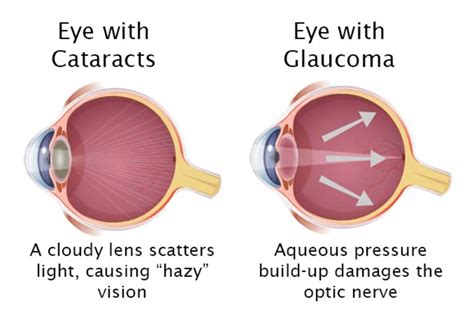 Whats The Difference Between Glaucoma And Cataracts