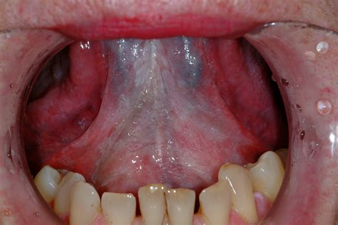 Floor Of Mouth Cancer Staging Review Home Decor