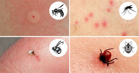 Common Bug Bites That You Should Recognize And Treat Accordingly