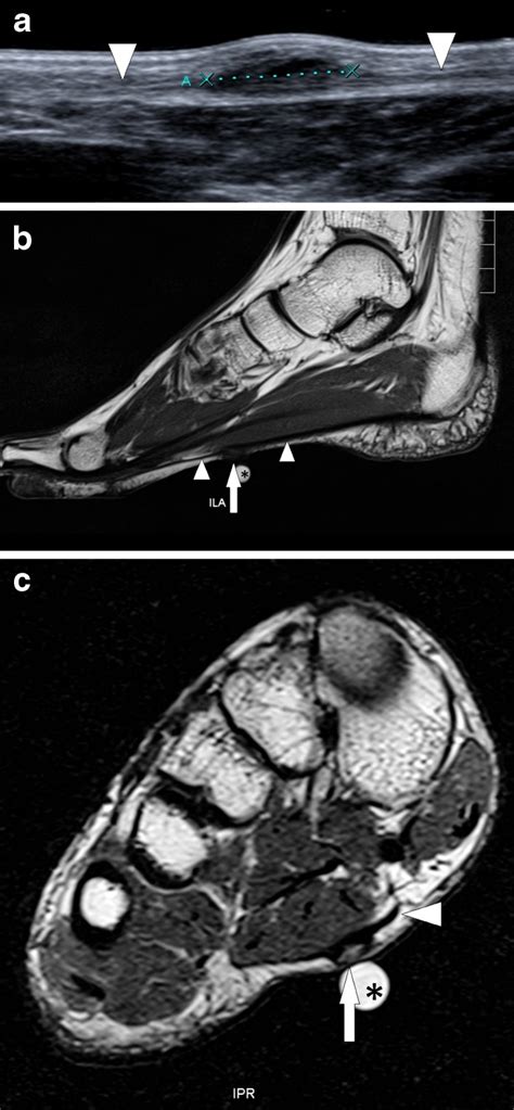 Plantar Fibromatosis Patient With A Painless Subcutaneous Nodule At