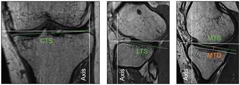 Comparison Of Size Of Posterior Tibial Slope And Medial Tibial Depth In