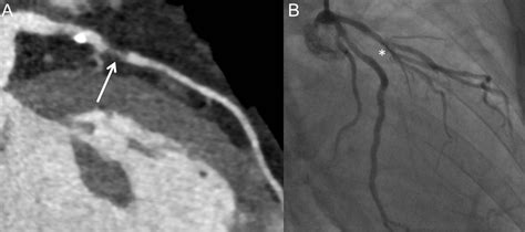 Coronary Ct Angiography For Patients With Suspected Coronary Artery