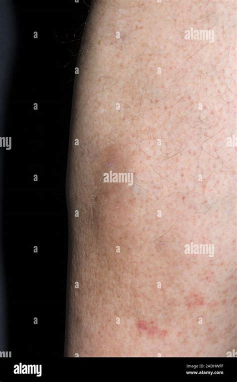 Model Released Haematoma Swelling On The Shin Of A 68 Year Old Man