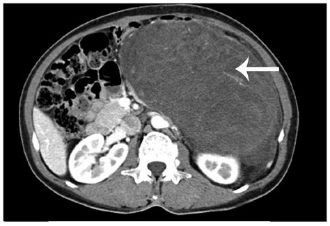Management Of Retroperitoneal Liposarcoma A Case Report And Review Of