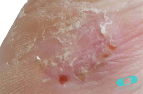 Online Dermatology Fungal Infections