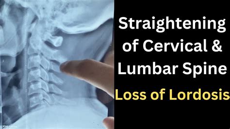 Straightening Of Cervical Curvature Loss Of Lumbar Lordosis Lumbar