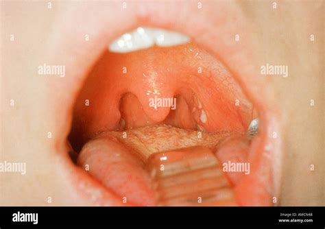 Glandular Fever Hi Res Stock Photography And Images Alamy