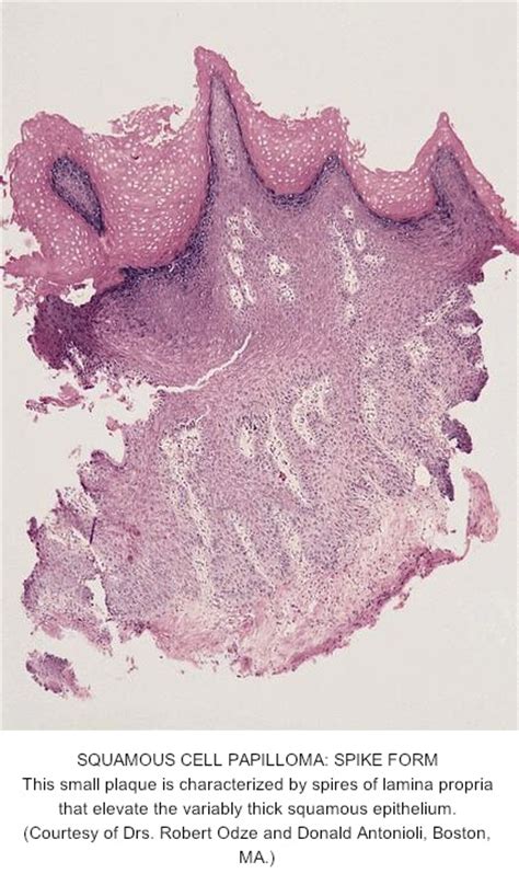 Pathology Outlines Squamous Papilloma Hot Sex Picture