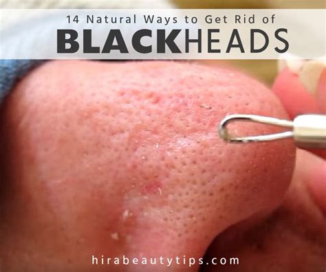 How To Remove Nose Blackheads Naturally Beautytips Get Rid Of