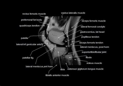 Free cross sectional anatomy of the knee based on mri : Knee Muscle Anatomy Mri - Mri Image Of Left Knee Of A 21 Year Old Patient With Intra Operative ...