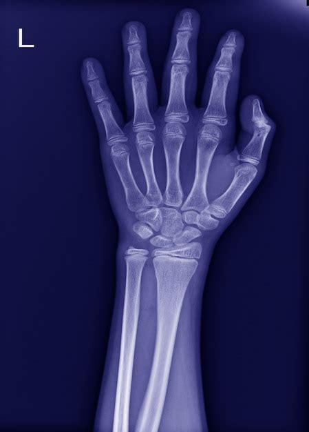 X Ray Left Wrist No Fracture And Normal Joint Premium Photo