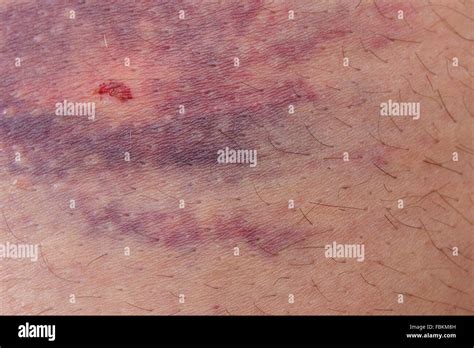 Closeup Of Bruise Stock Photo Alamy