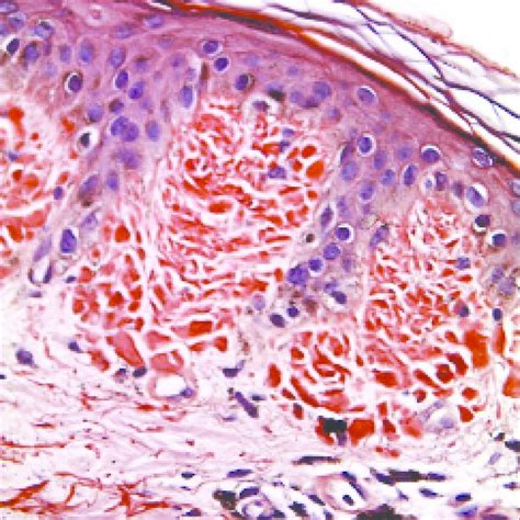 Multiple Hypopigmented And Depigmented Macules Over Upper Back With Few