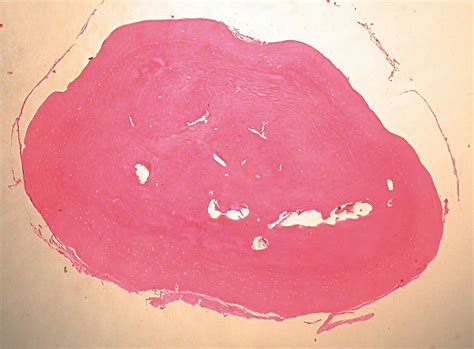 Multiple Pigmented Nodules—quiz Case Acne Jama Dermatology Jama