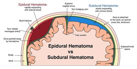 Epidural Hematoma Epidural Hemorrhage Etiology Clinical Features