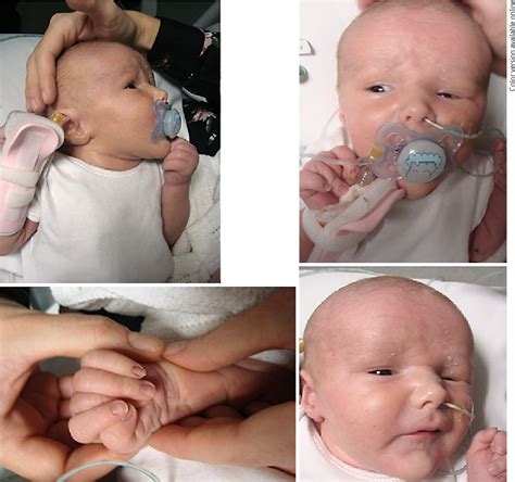 Figure 1 From Sotos Syndrome Presenting With Neonatal Hyperinsulinaemic
