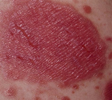 Plaque Psoriasis Severe Current Health Advice Health Blog Articles