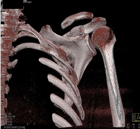 Scapular Fracture Musculoskeletal Case Studies Ctisus Ct Scanning