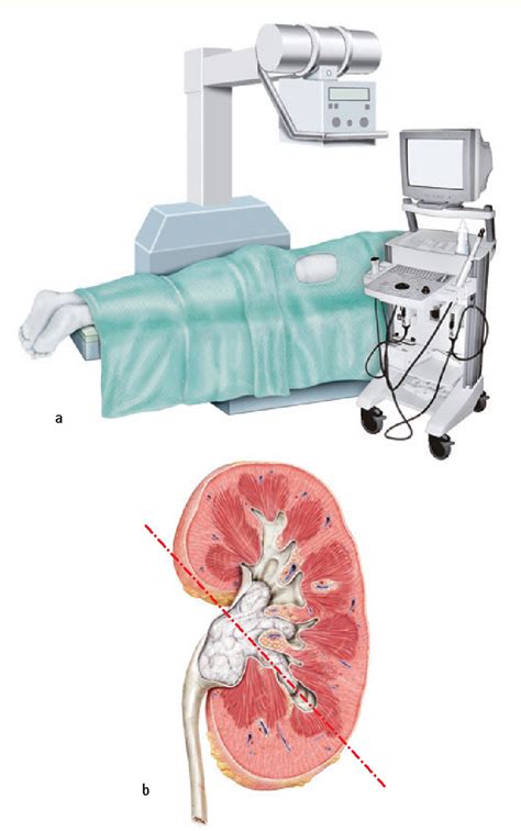 Percutaneous Nephrolithotomy