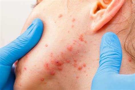 Gags And Iga Scoring Systems Are Reliable Correlated For Acne Severity