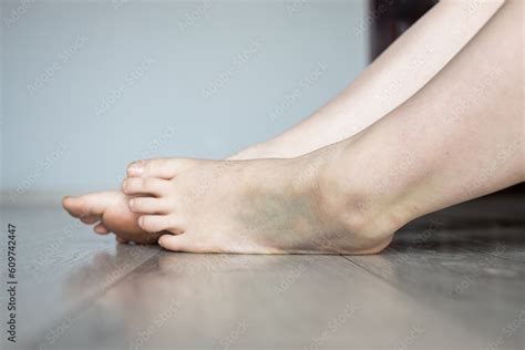 Bruise Injury On Young Woman Foot Close Up Image Of Female Person