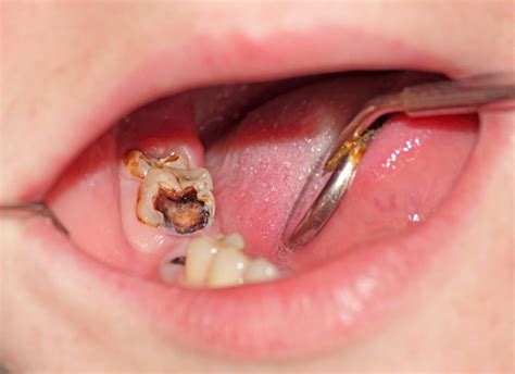 Tooth Decay Dentist Brisbane