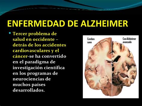 La enfermedad es considerada como cualquier estado donde haya un deterioro de la salud del organismo humano. Enfermedad de alzheimer