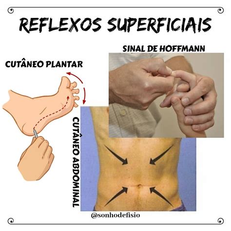 Reflexos Superficiais SINAL DE HOFFMANN Ou Reflexo Dos Flexores Dos Dedos SUPERF
