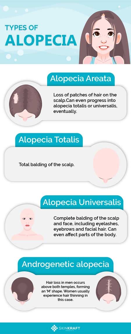 Alopecia Areata Heres Everything You Should Know About It Skinkraft