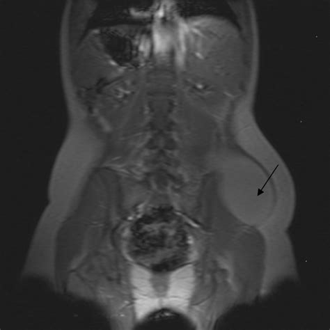 Diagnosis And Treatment Of Giant Lateral Abdominal Wall Haematoma After