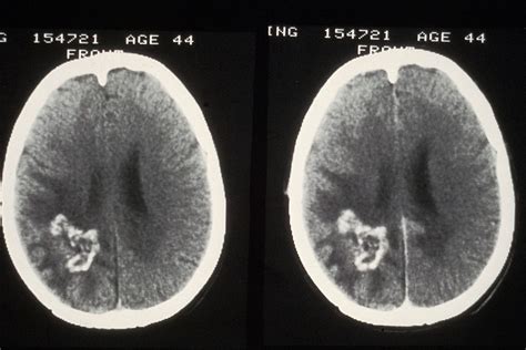 What Does A Brain Tumor Look Like On A Ct Scan Ct Scan Machine Images