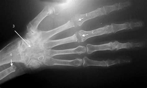 Rheumatoid Arthritis Hand Surgery Source