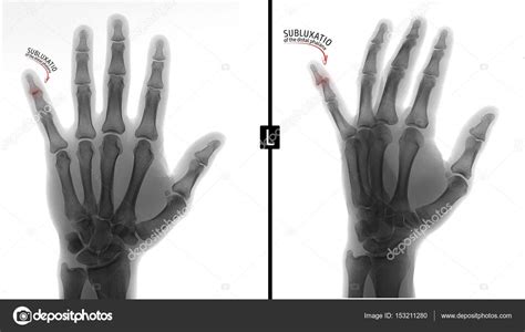 X Ray Hand
