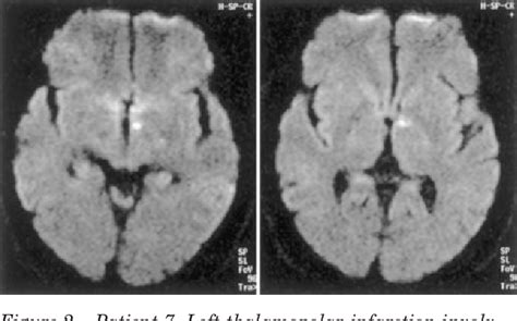 Central Horners Syndrome With Contralateral Ataxic Hemiparesis