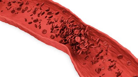 Blood Clots What Causes Blood Clots