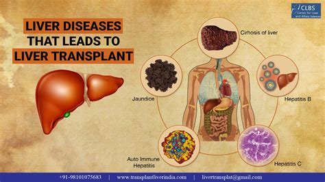 Liver Diseases That Leads To Liver Transplant Max Clbs